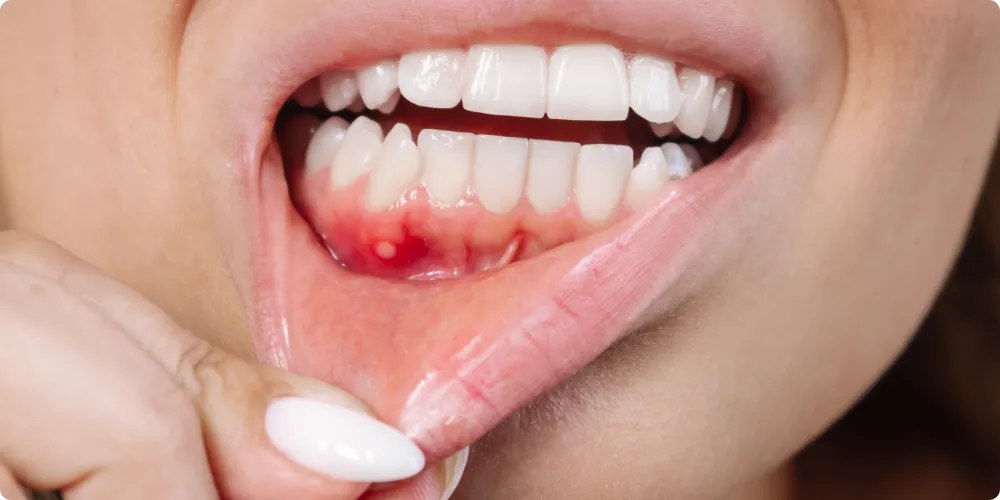 Periodontoloji Tedavisi